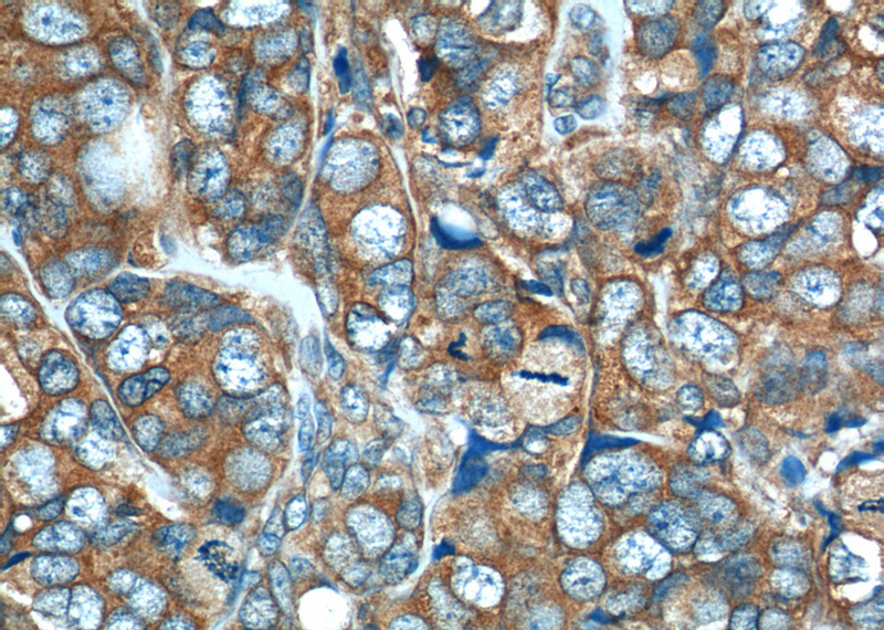 Immunohistochemistry of paraffin-embedded human breast cancer tissue slide using Catalog No:110768(GAB2 Antibody) at dilution of 1:50 (under 40x lens)