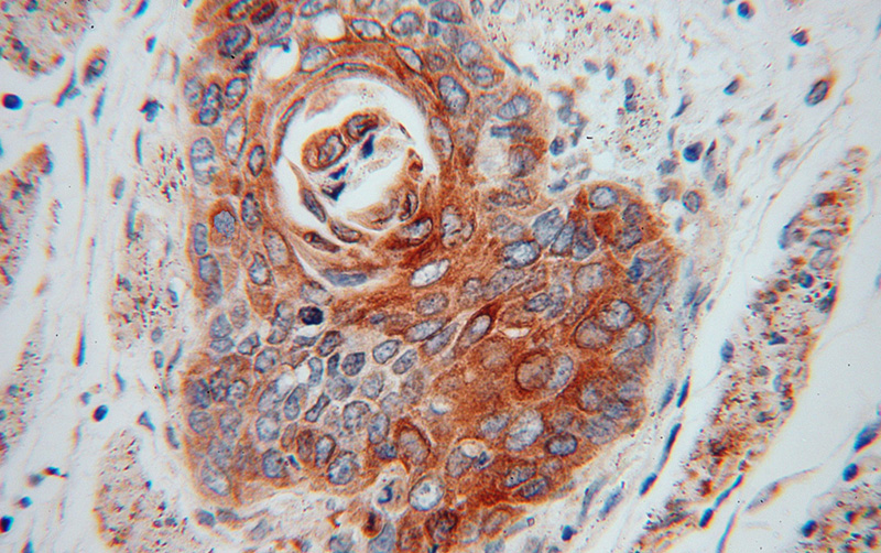 Immunohistochemical of paraffin-embedded human colon cancer using Catalog No:110356(ERGIC1 antibody) at dilution of 1:100 (under 40x lens)