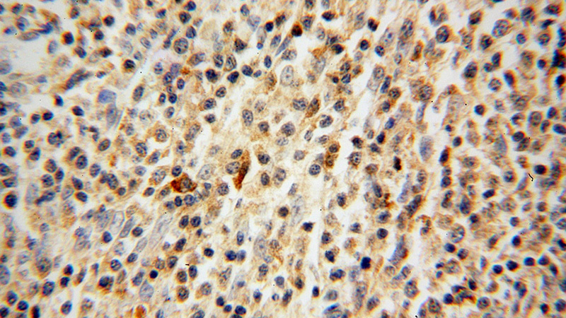 Immunohistochemical of paraffin-embedded human lymphoma using Catalog No:111322(GZMB antibody) at dilution of 1:100 (under 40x lens)