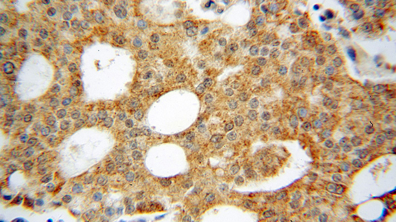 Immunohistochemical of paraffin-embedded human prostate cancer using Catalog No:110780(FSCN3 antibody) at dilution of 1:50 (under 40x lens)