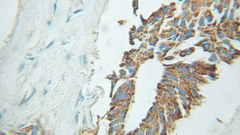 Immunohistochemical of paraffin-embedded human prostate cancer using Catalog No:110183(EIF2B3 antibody) at dilution of 1:50 (under 10x lens)