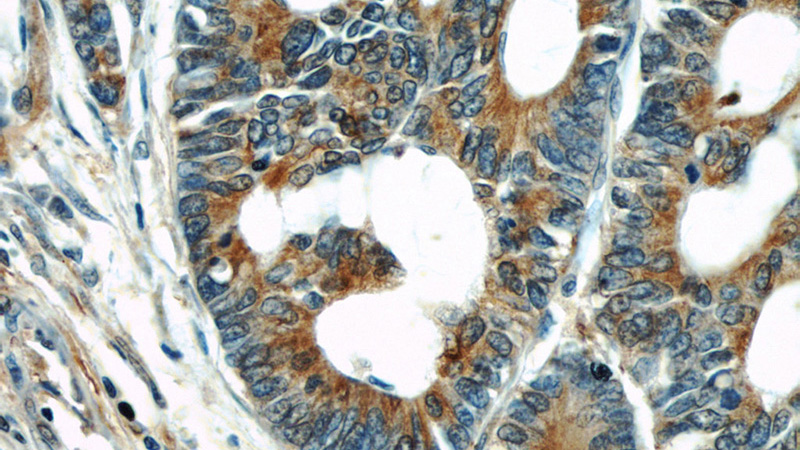Immunohistochemical of paraffin-embedded human colon cancer using Catalog No:117297(Tubulin-Alpha antibody) at dilution of 1:50 (under 40x lens)