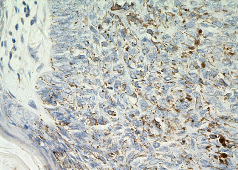 Immunohistochemical of paraffin-embedded human skin cancer using Catalog No:110216(EGFR antibody) at dilution of 1:50 (under 40x lens)