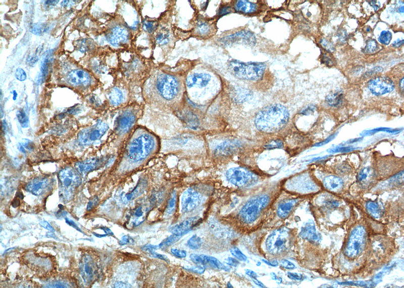 Immunohistochemistry of paraffin-embedded human lung cancer tissue slide using (SLC2A1,GLUT1 Antibody) at dilution of 1:300 (under 40x lens).
