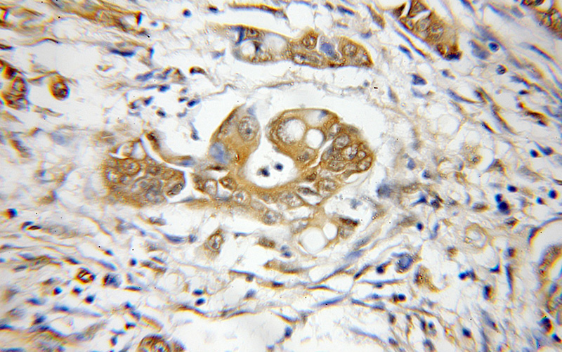 Immunohistochemical of paraffin-embedded human colon cancer using Catalog No:114399(PSMD3 antibody) at dilution of 1:50 (under 10x lens)