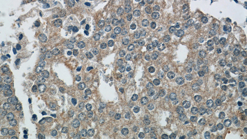 Immunohistochemical of paraffin-embedded human prostate cancer using Catalog No:111902(KLK11 antibody) at dilution of 1:200 (under 40x lens)
