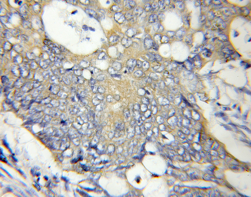 Immunohistochemical of paraffin-embedded human colon cancer using Catalog No:108321(ATPAF2 antibody) at dilution of 1:50 (under 10x lens)