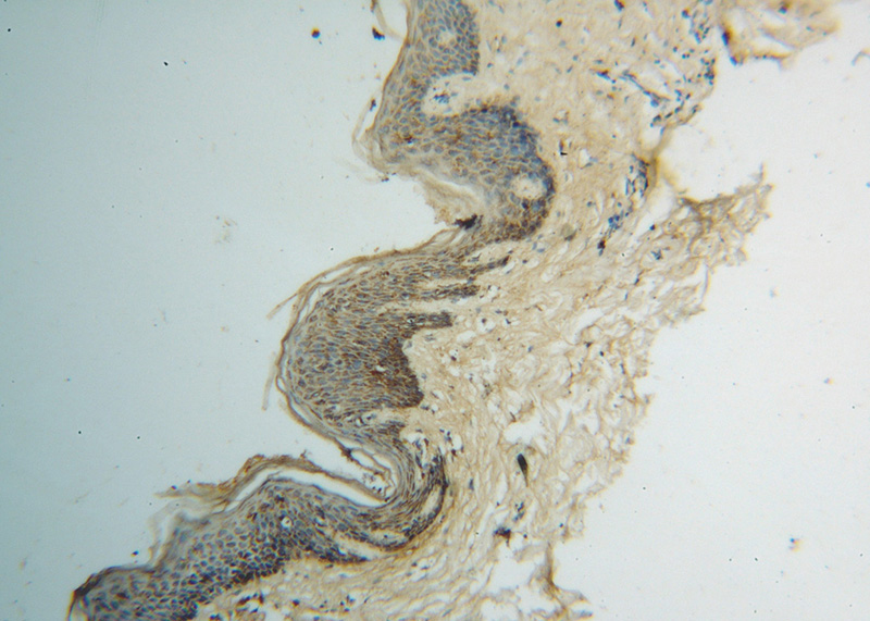 Immunohistochemical of paraffin-embedded human skin cancer using Catalog No:111051(GOT2 antibody) at dilution of 1:100 (under 10x lens)