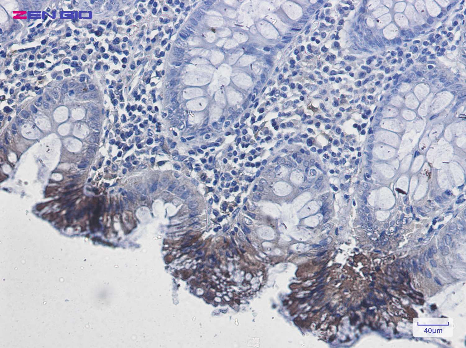 Immunohistochemistry of Rab9 in paraffin-embedded Human colon cancer tissue using Rab9 Rabbit pAb at dilution 1/50