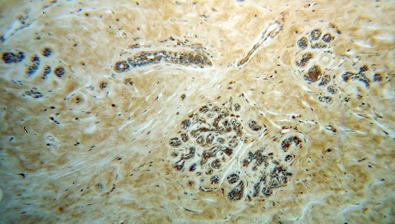 Immunohistochemical of paraffin-embedded human breast cancer using Catalog No:113036(NCK1 antibody) at dilution of 1:100 (under 10x lens)