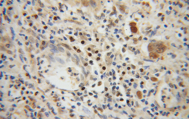 Immunohistochemical of paraffin-embedded human cervical cancer using Catalog No:115904(TCF12 antibody) at dilution of 1:50 (under 40x lens)
