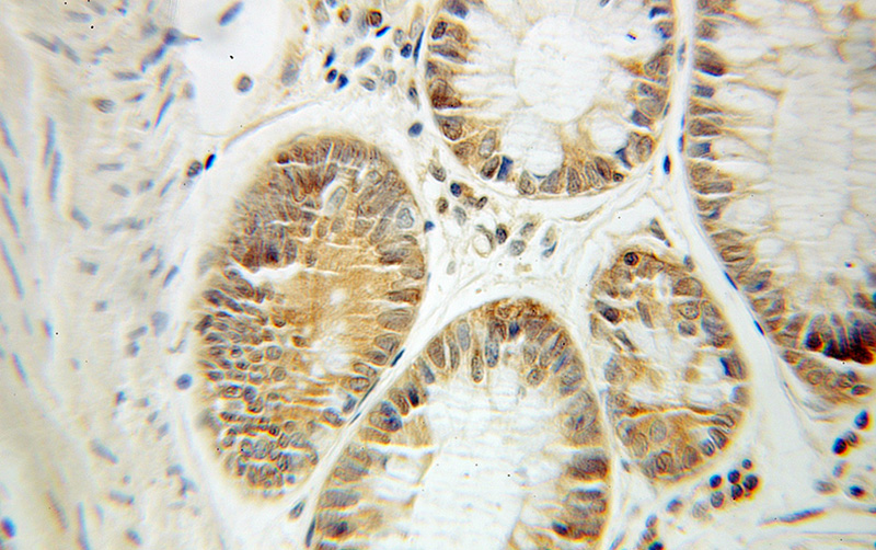 Immunohistochemical of paraffin-embedded human colon cancer using Catalog No:109082(CCT3 antibody) at dilution of 1:50 (under 10x lens)