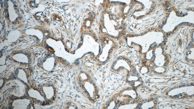 Immunohistochemistry of paraffin-embedded human breast cancer tissue slide using Catalog No:116608(USP34 Antibody) at dilution of 1:50 (under 10x lens)