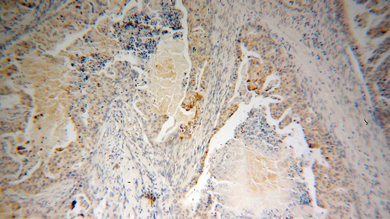 Immunohistochemical of paraffin-embedded human stomach cancer using Catalog No:116354(TFF1 antibody) at dilution of 1:50 (under 10x lens)