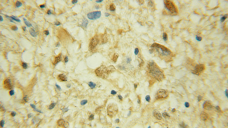 Immunohistochemical of paraffin-embedded human gliomas using Catalog No:109581(CRTC2,TORC2 antibody) at dilution of 1:100 (under 10x lens)