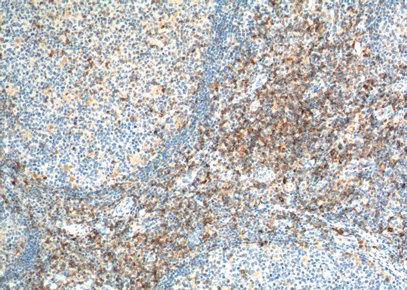 Immunohistochemistry of paraffin-embedded human tonsillitis tissue slide using Catalog No:109035(CD4 Antibody) at dilution of 1:200 (under 10x lens). heat mediated antigen retrieved with Tris-EDTA buffer(pH9).