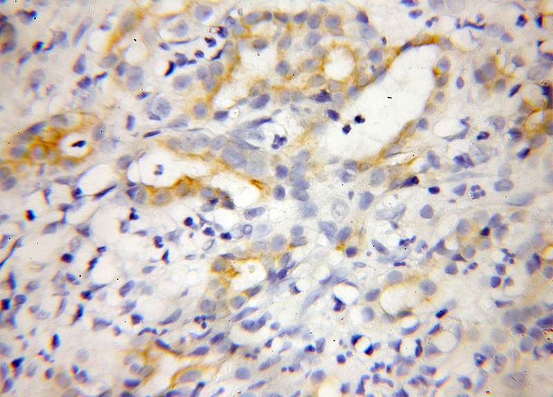 Immunohistochemical of paraffin-embedded human pancreas cancer using Catalog No:114682(REEP6 antibody) at dilution of 1:50 (under 10x lens)