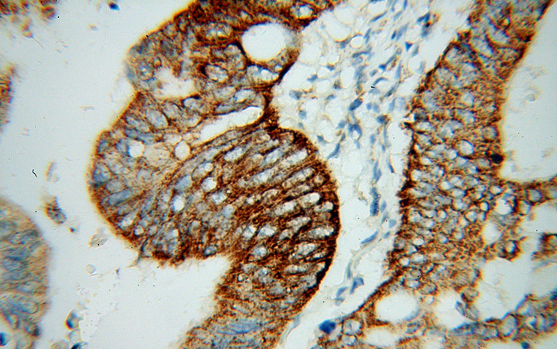 Immunohistochemical of paraffin-embedded human colon cancer using Catalog No:115820(SUCLG2 antibody) at dilution of 1:100 (under 40x lens)