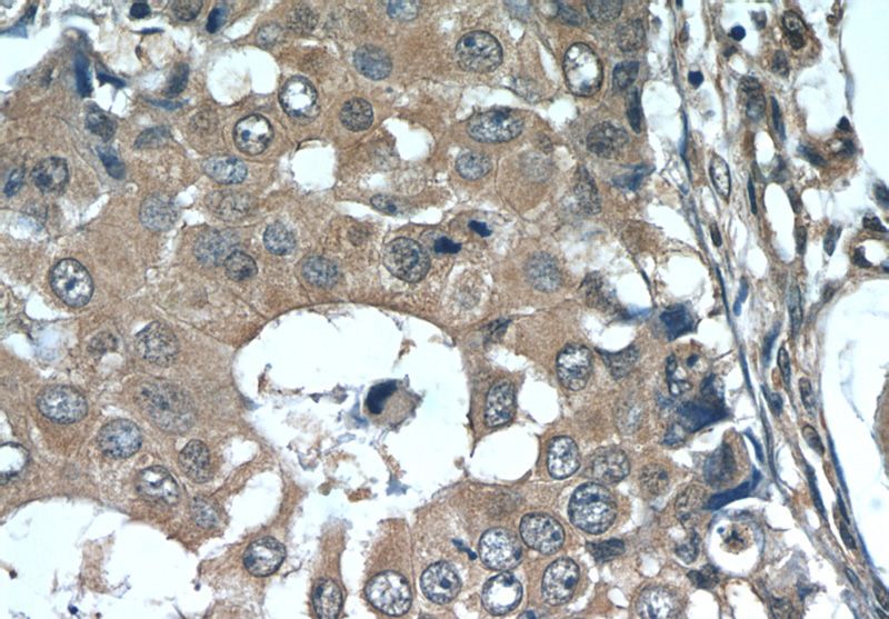 Immunohistochemistry of paraffin-embedded human breast cancer tissue slide using Catalog No:114886(RPL29 Antibody) at dilution of 1:50 (under 40x lens)