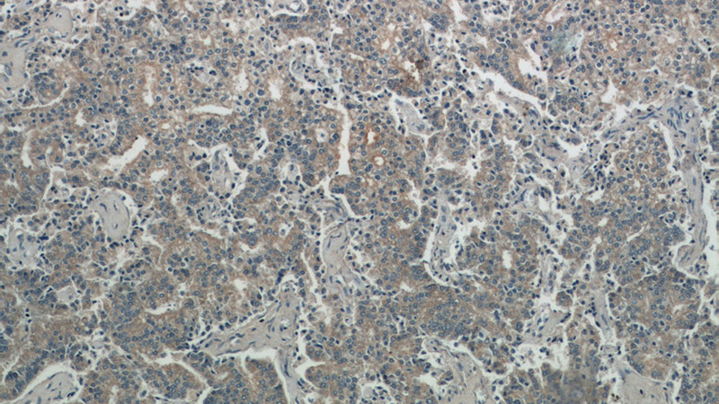 Immunohistochemistry of paraffin-embedded human prostate cancer tissue slide using Catalog No:109729(CTPS2 Antibody) at dilution of 1:50 (under 10x lens)