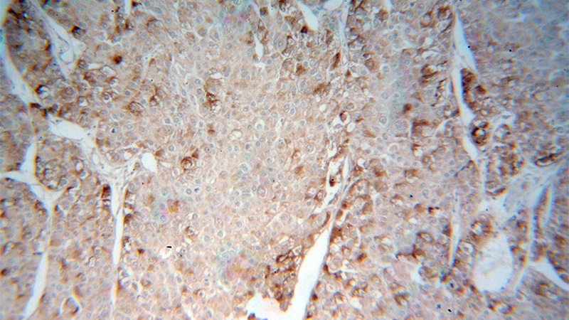 Immunohistochemical of paraffin-embedded human liver cancer using Catalog No:117072(AUP1 antibody) at dilution of 1:100 (under 10x lens)