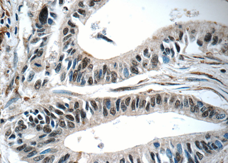 Immunohistochemistry of paraffin-embedded human pancreas cancer tissue slide using Catalog No:112616(MIER1 Antibody) at dilution of 1:50 (under 40x lens)