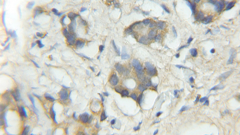 Immunohistochemical of paraffin-embedded human prostate cancer using Catalog No:116319(TRIM5 antibody) at dilution of 1:50 (under 10x lens)