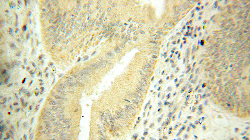 Immunohistochemical of paraffin-embedded human ovary tumor using Catalog No:112579(Mecr antibody) at dilution of 1:50 (under 10x lens)