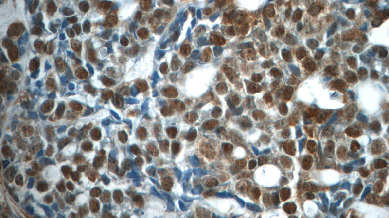 Immunohistochemistry of paraffin-embedded human cervical cancer tissue slide using Catalog No:110156(E2F7 Antibody) at dilution of 1:50 (under 40x lens)