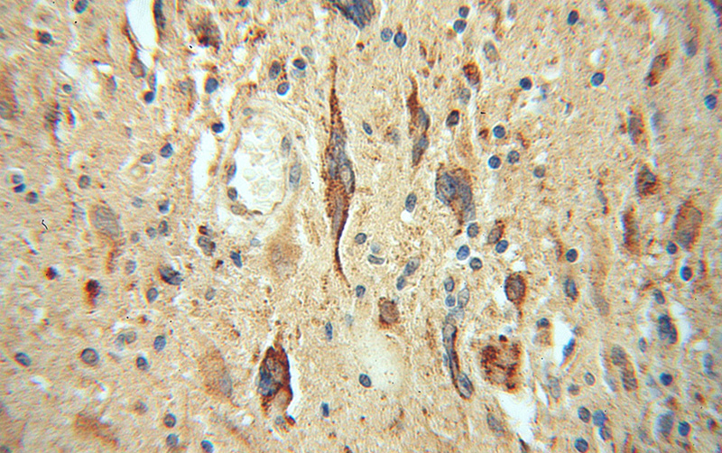 Immunohistochemical of paraffin-embedded human gliomas using Catalog No:112335(LRRC4C antibody) at dilution of 1:50 (under 40x lens)