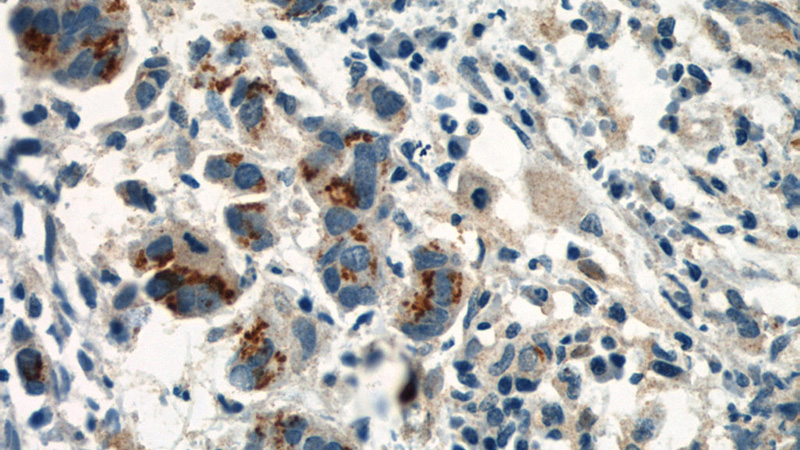 Immunohistochemistry of paraffin-embedded human prostate cancer slide using Catalog No:107472(PIK3R1 Antibody) at dilution of 1:50