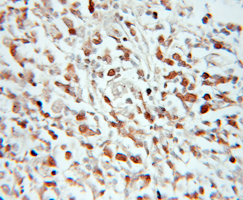 Immunohistochemical of paraffin-embedded human lymphoma using Catalog No:108225(ASF1B antibody) at dilution of 1:100 (under 10x lens)