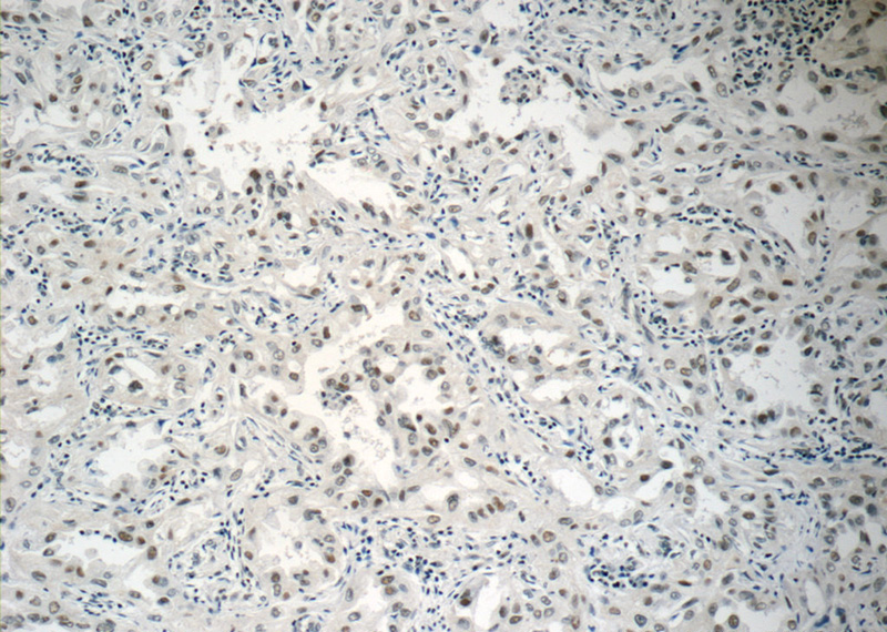 Immunohistochemistry of paraffin-embedded human lung cancer tissue slide using Catalog No:113738(PCIF1 Antibody) at dilution of 1:50 (under 10x lens)