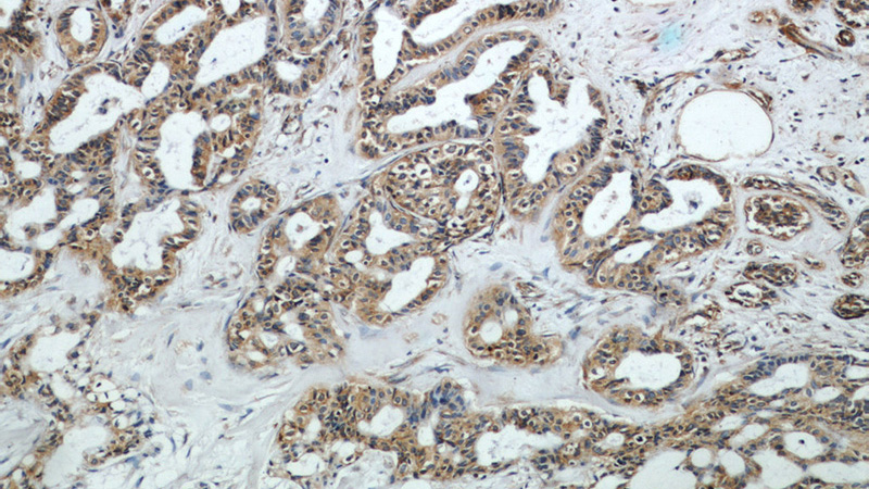 Immunohistochemical of paraffin-embedded human breast cancer using Catalog No:109188(CEP97 antibody) at dilution of 1:50 (under 10x lens)