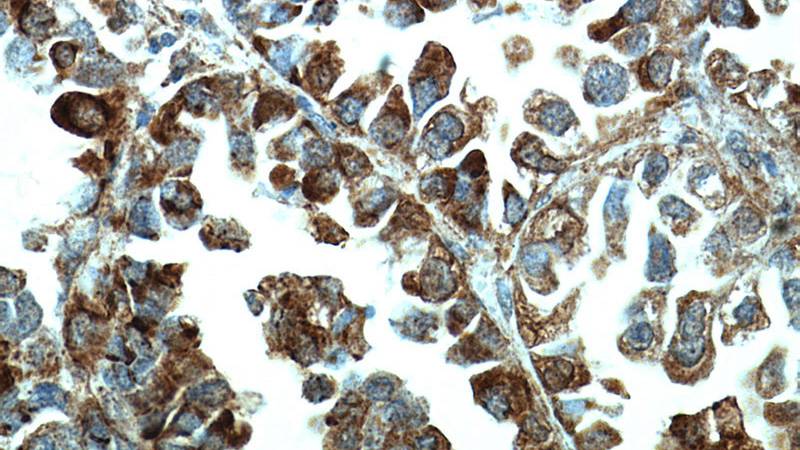 Immunohistochemical of paraffin-embedded human lung cancer using Catalog No:112748(MPP3 antibody) at dilution of 1:50 (under 40x lens)