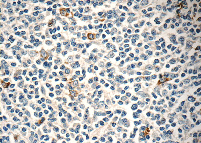 Immunohistochemistry of paraffin-embedded human tonsillitis tissue slide using Catalog No:116162(C3orf23 Antibody) at dilution of 1:50 (under 40x lens)