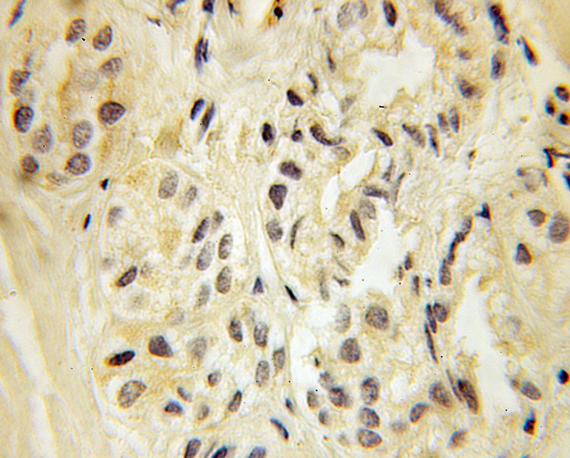 Immunohistochemical of paraffin-embedded human prostate cancer using Catalog No:111913(KAT5 antibody) at dilution of 1:100 (under 10x lens)