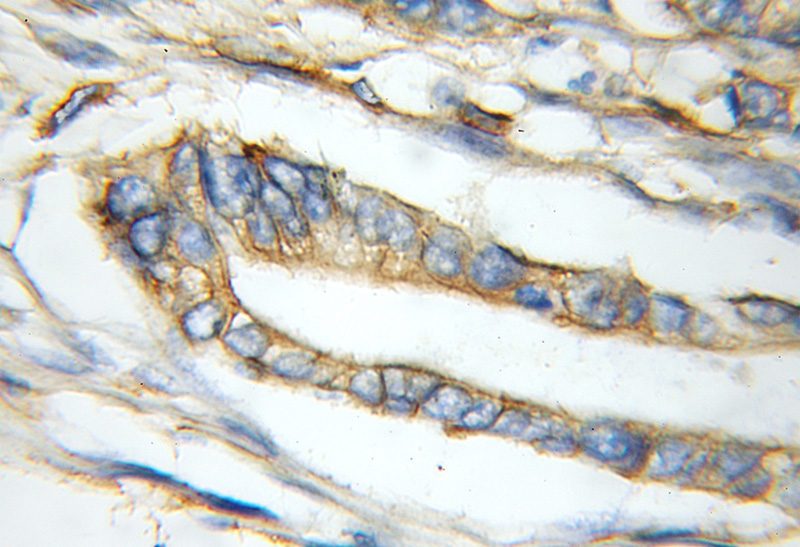 Immunohistochemical of paraffin-embedded human pancreas cancer using Catalog No:114012(PLSCR1 antibody) at dilution of 1:100 (under 10x lens)