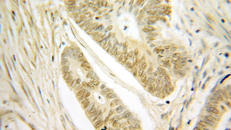 Immunohistochemical of paraffin-embedded human colon cancer using Catalog No:112282(LMNB2 antibody) at dilution of 1:100 (under 10x lens)