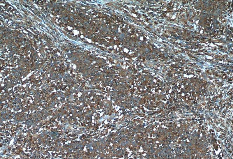Immunohistochemistry of paraffin-embedded human colon cancer tissue slide using Catalog No:108392(B4GALNT2 Antibody) at dilution of 1:50 (under 10x lens)