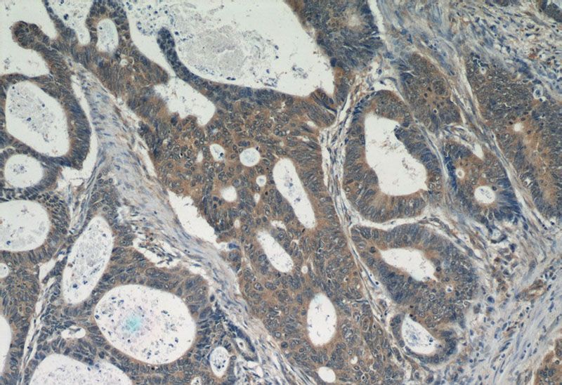 Immunohistochemistry of paraffin-embedded human colon cancer tissue slide using Catalog No:110619(FER Antibody) at dilution of 1:50 (under 10x lens)