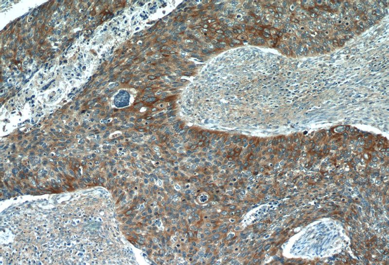 Immunohistochemistry of paraffin-embedded human cervical cancer tissue slide using Catalog No:109797(KRT17 Antibody) at dilution of 1:50 (under 10x lens)