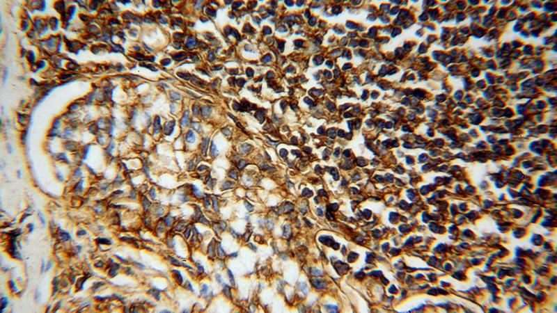 Immunohistochemical of paraffin-embedded human stomach cancer using Catalog No:111414(HLA class I (HLA-A) antibody) at dilution of 1:100 (under 40x lens)