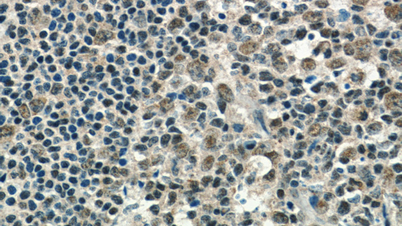 Immunohistochemistry of paraffin-embedded human tonsillitis tissue slide using Catalog No:110274(ELF1 Antibody) at dilution of 1:50