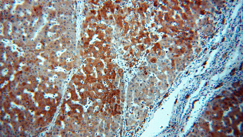 Immunohistochemical of paraffin-embedded human hepatocirrhosis using Catalog No:109908(DGUOK antibody) at dilution of 1:100 (under 10x lens)