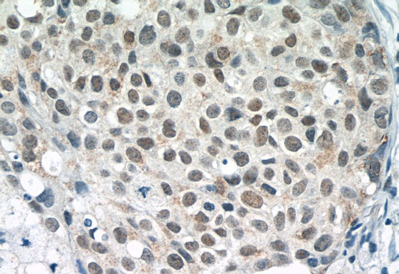 Immunohistochemistry of paraffin-embedded human breast cancer tissue slide using Catalog No:111406(Histone H2B Antibody) at dilution of 1:50 (under 40x lens)