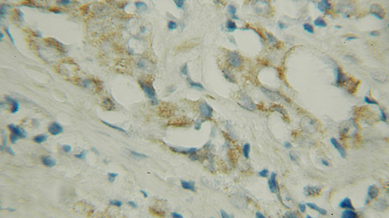 Immunohistochemical of paraffin-embedded human prostate cancer using Catalog No:109718(CTBS antibody) at dilution of 1:50 (under 40x lens)