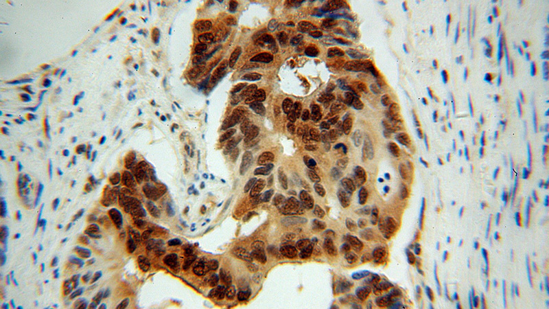 Immunohistochemical of paraffin-embedded human colon cancer using Catalog No:107894(ADRM1 antibody) at dilution of 1:100 (under 40x lens)