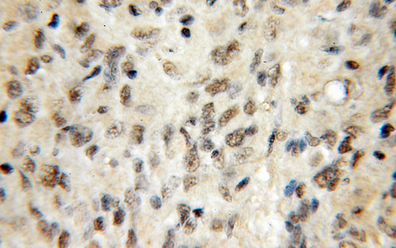Immunohistochemical of paraffin-embedded human gliomas using Catalog No:108228(ASH2L antibody) at dilution of 1:50 (under 10x lens)