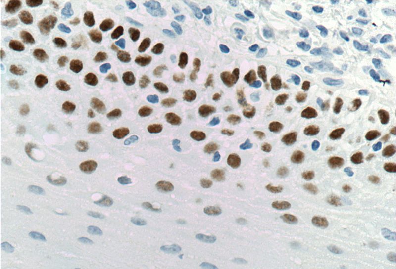 Immunohistochemistry of paraffin-embedded human tonsillitis tissue slide using Catalog No:113558(TP63 Antibody) at dilution of 1:200 (under 40x lens)